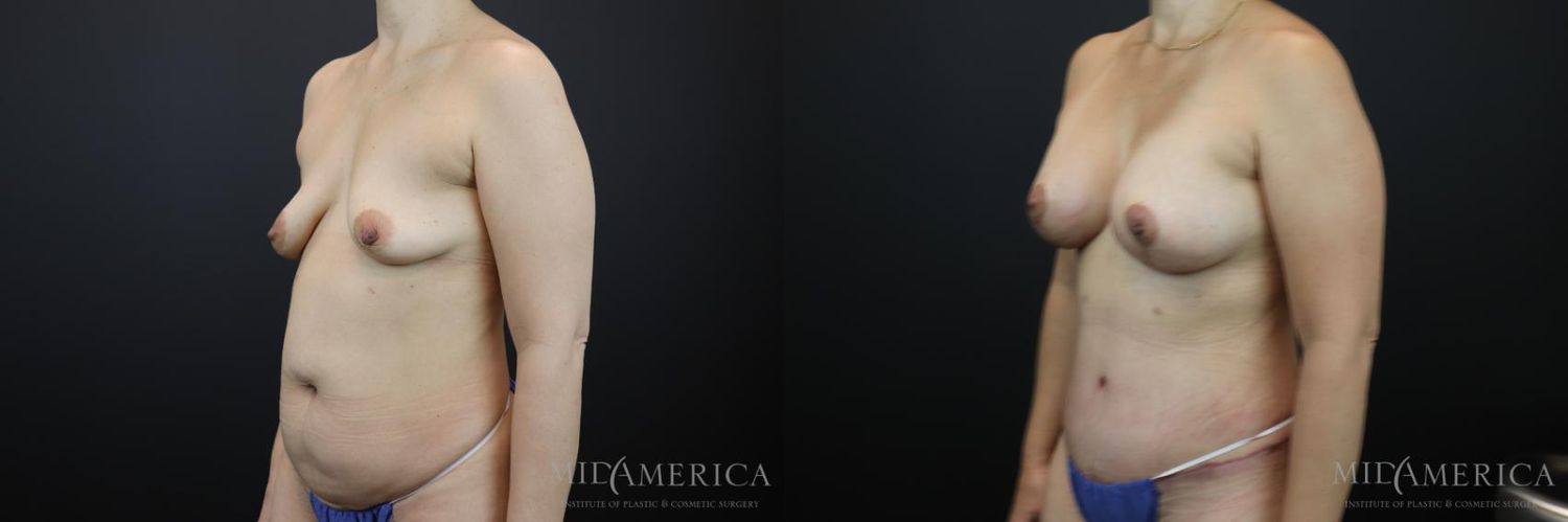 Mommy Makeover Before & After