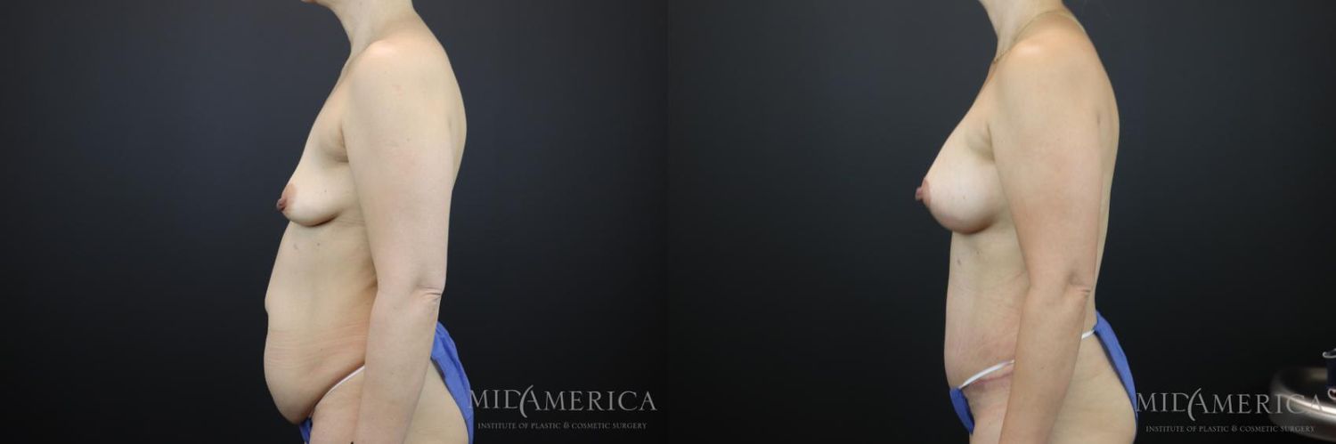 Mommy Makeover Before & After