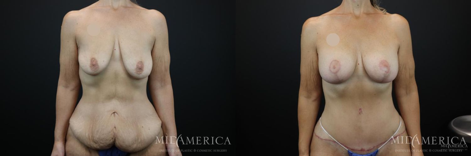 Mommy Makeover Before & After