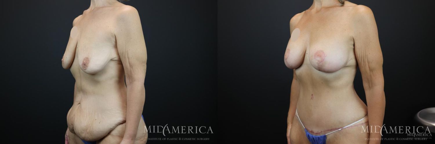 Mommy Makeover Before & After