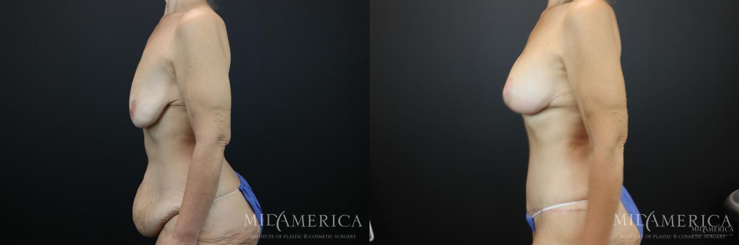 Mommy Makeover Before & After