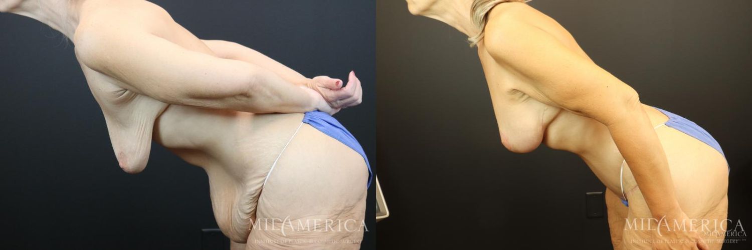 Mommy Makeover Before & After