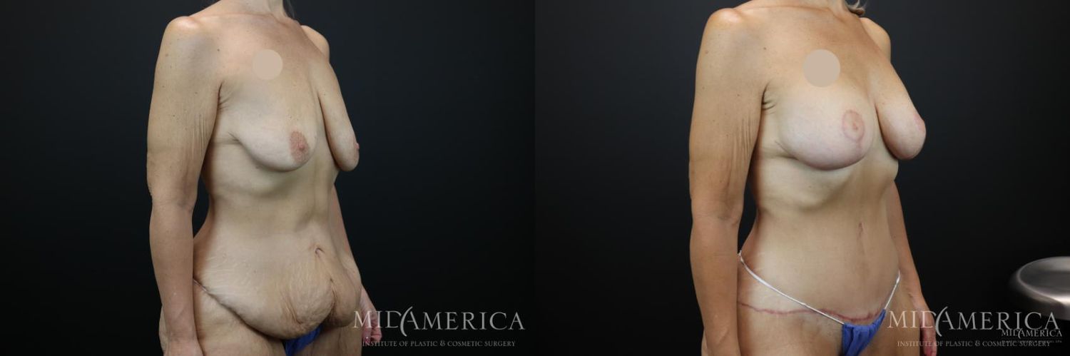 Mommy Makeover Before & After