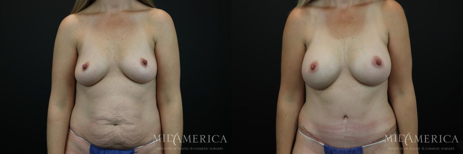 Mommy Makeover Before & After