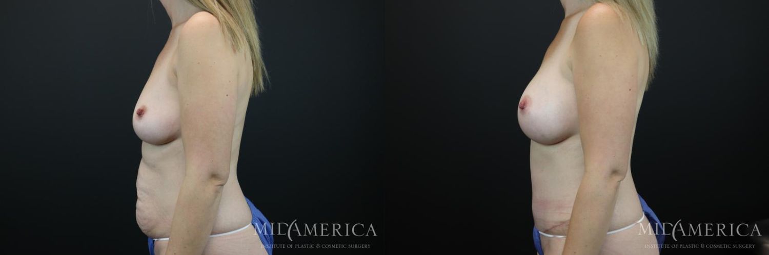 Mommy Makeover Before & After