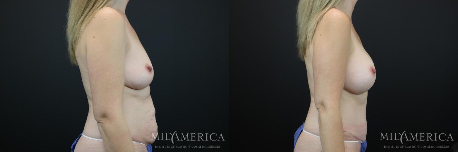 Mommy Makeover Before & After