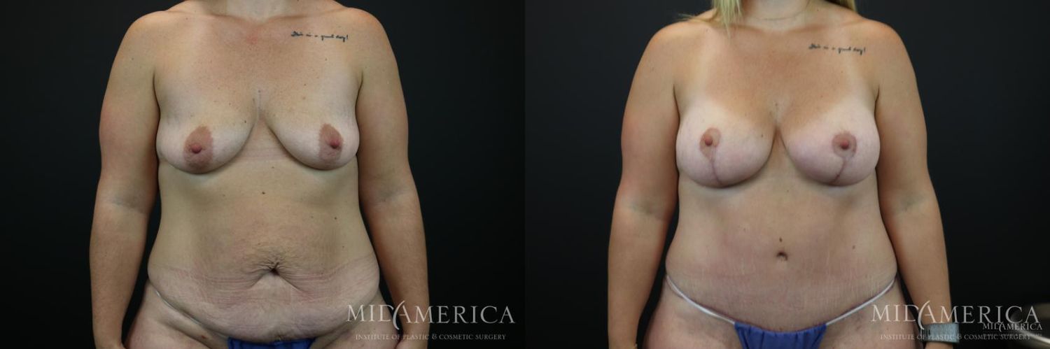 Mommy Makeover Before & After