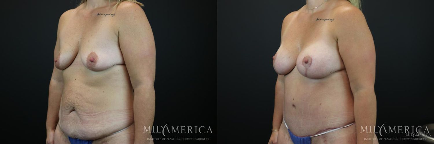 Mommy Makeover Before & After