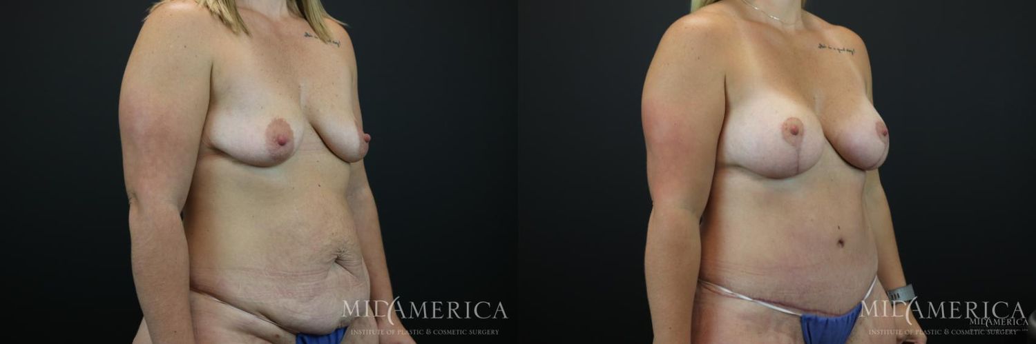 Mommy Makeover Before & After