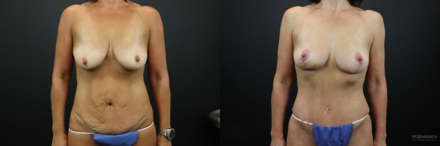 Mommy Makeover Before & After