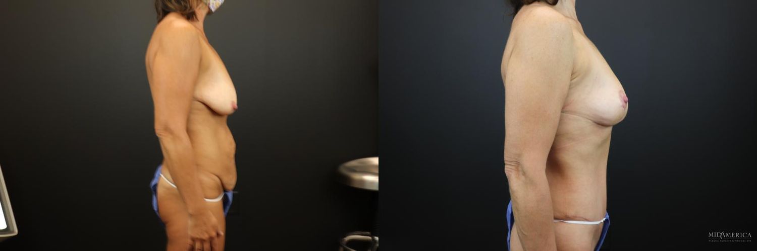 Mommy Makeover Before & After