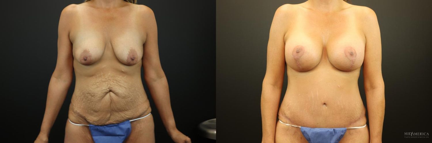 Mommy Makeover Before & After