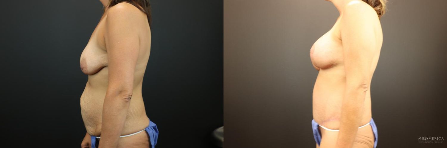 Mommy Makeover Before & After