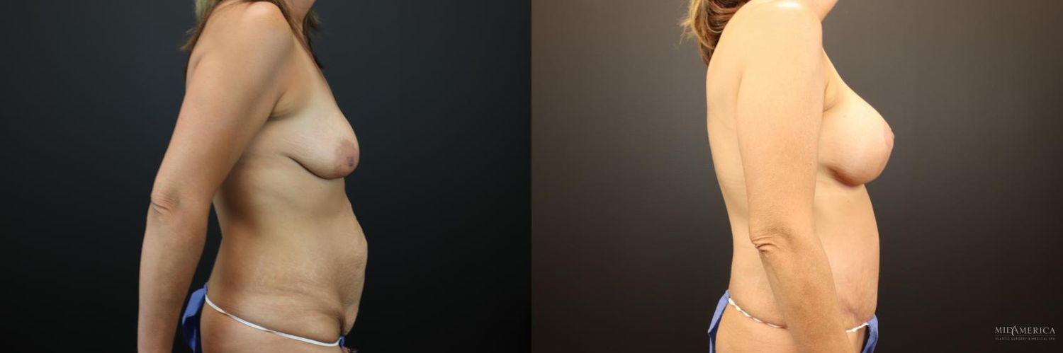 Mommy Makeover Before & After