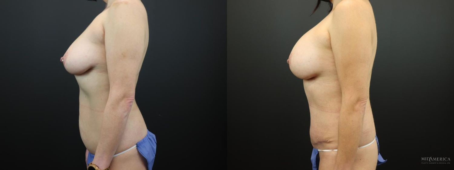 Mommy Makeover Before & After