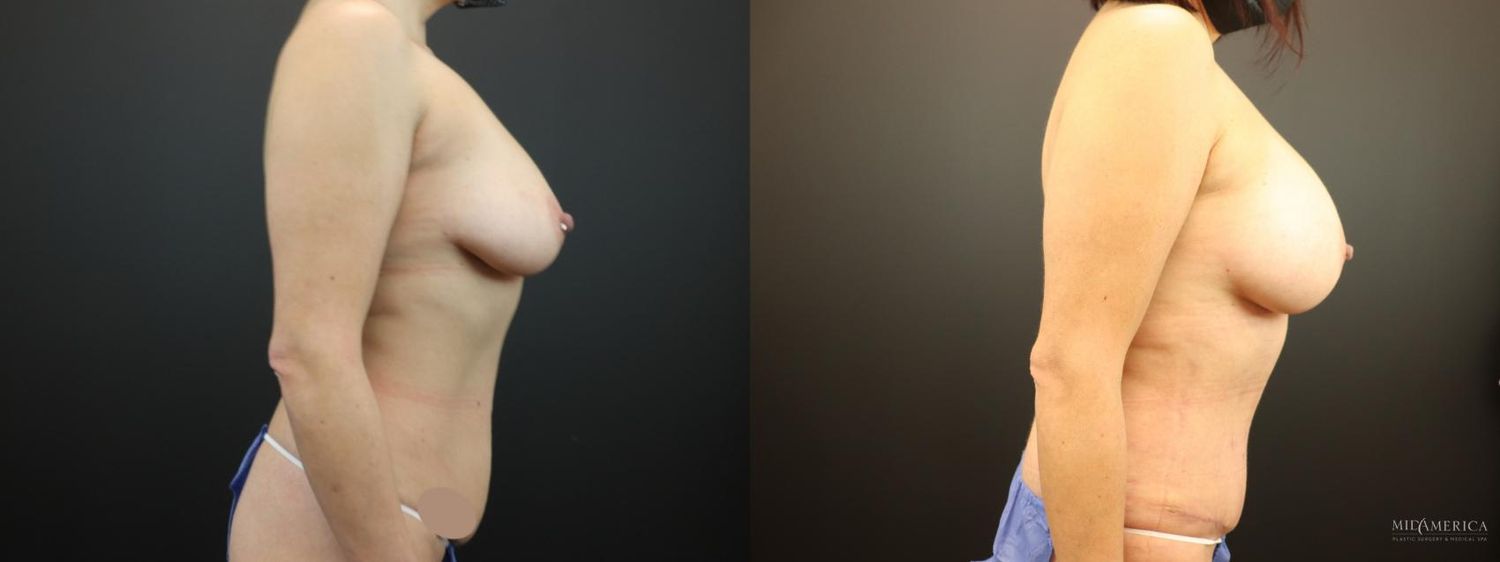 Mommy Makeover Before & After