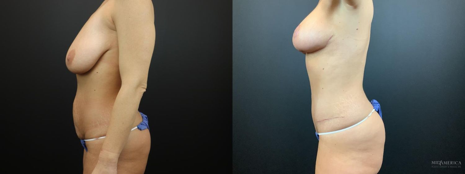 Mommy Makeover Before & After