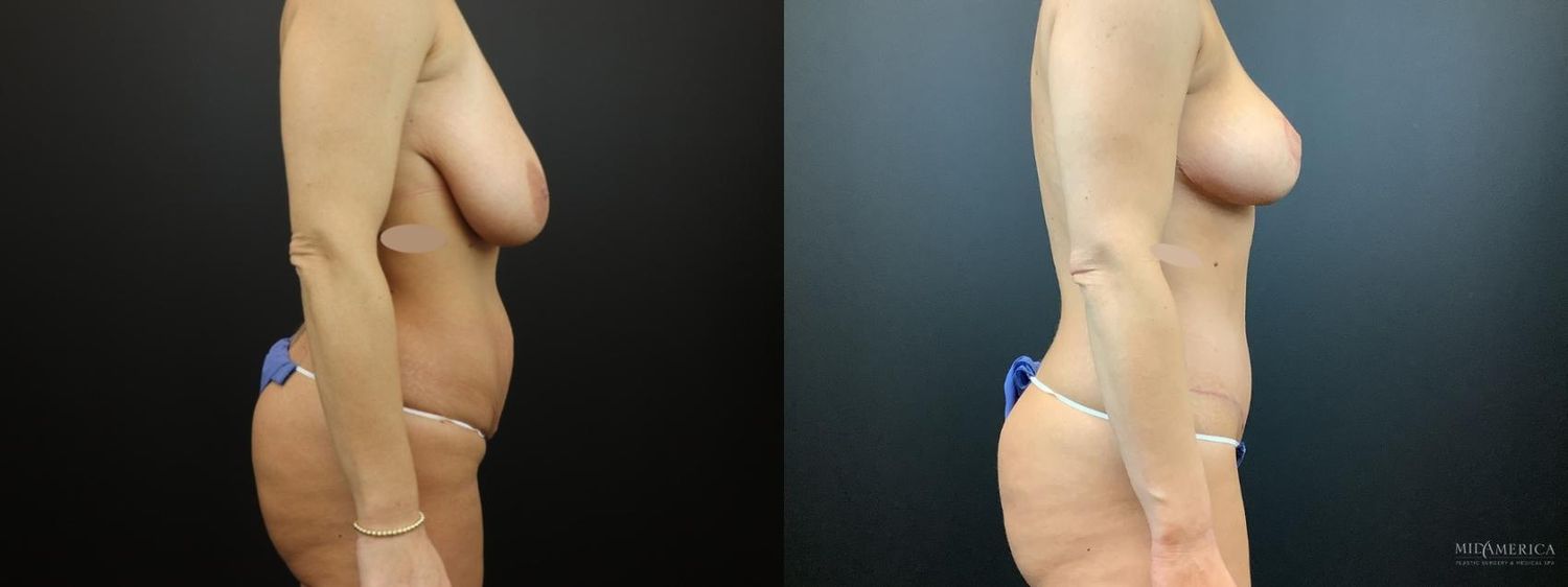 Mommy Makeover Before & After