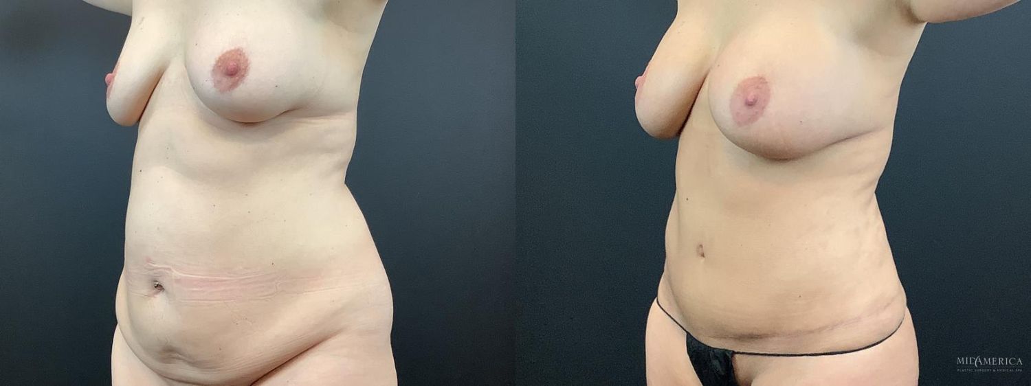 Mommy Makeover Before & After