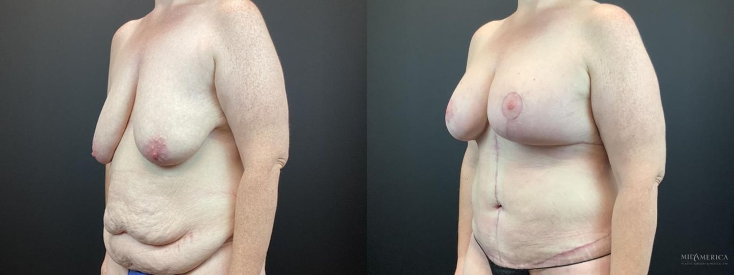 Mommy Makeover Before & After