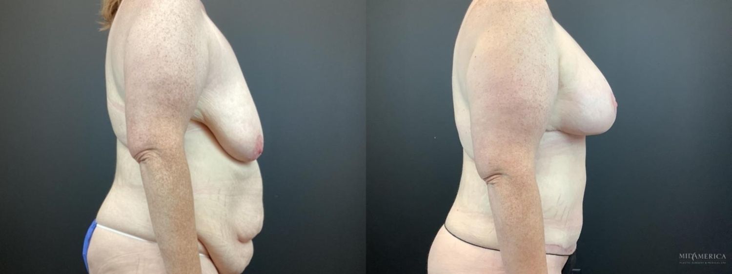 Mommy Makeover Before & After