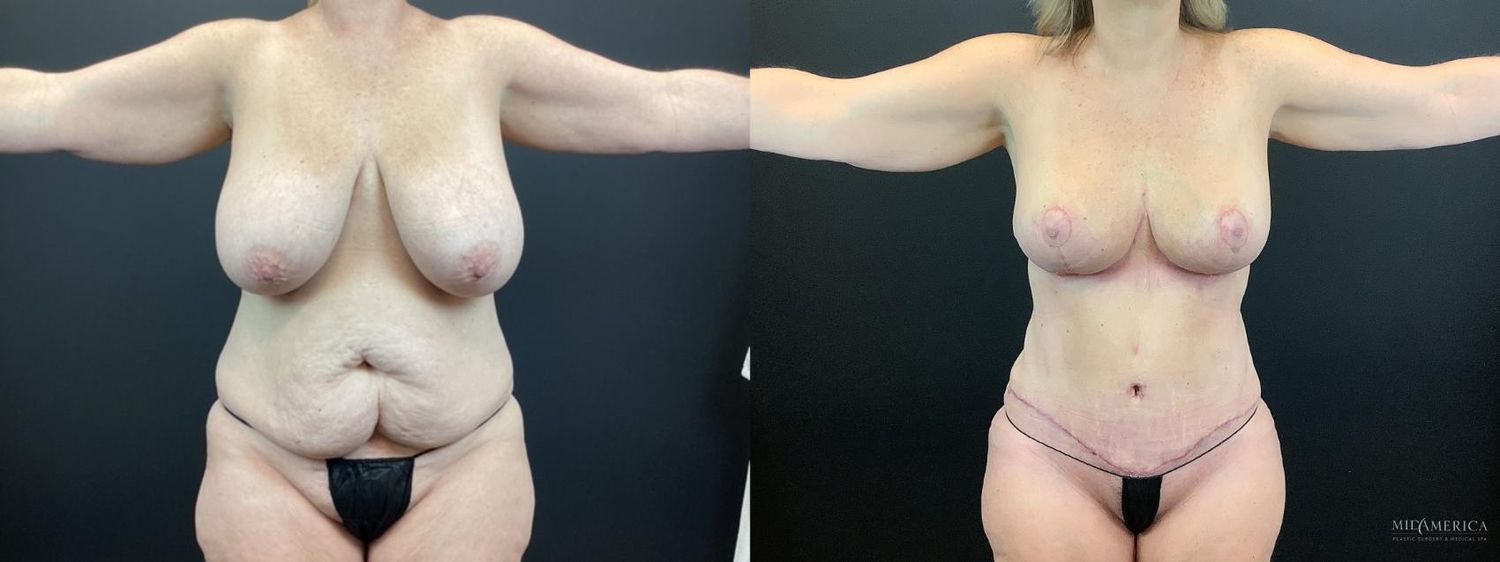 Mommy Makeover Before & After