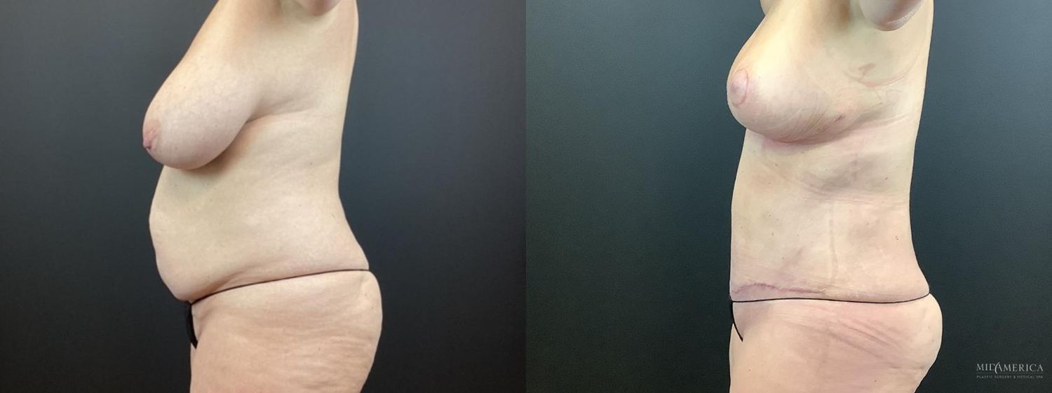 Mommy Makeover Before & After