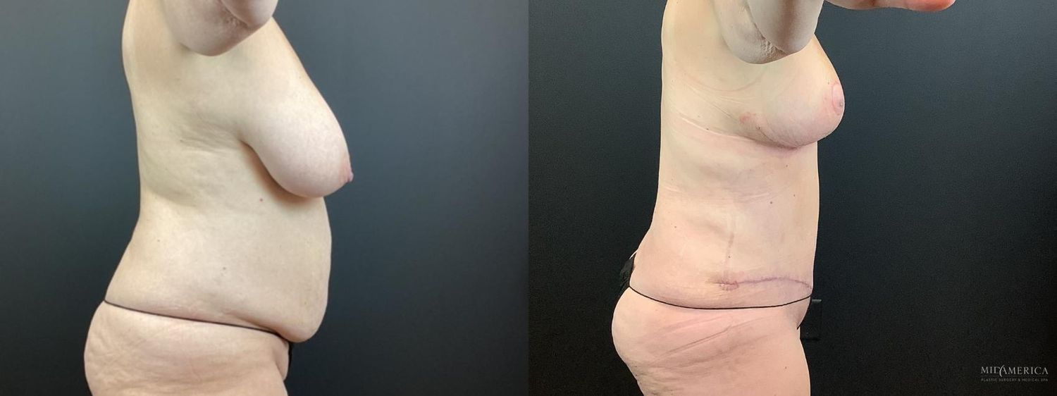 Mommy Makeover Before & After