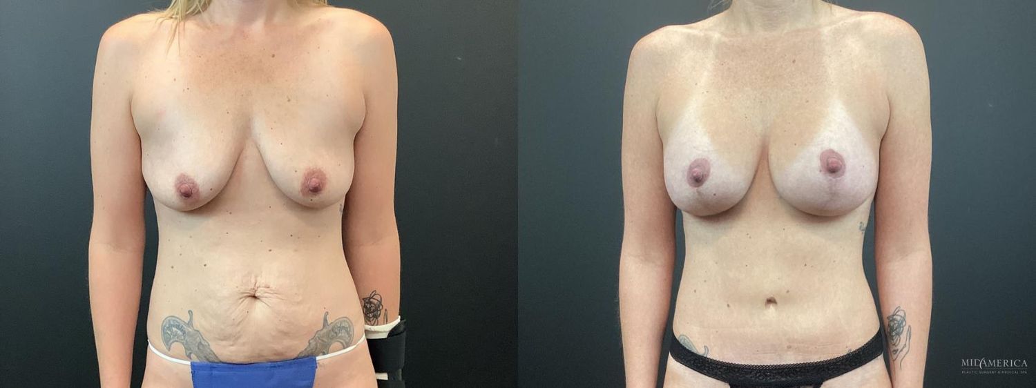 Mommy Makeover Before & After