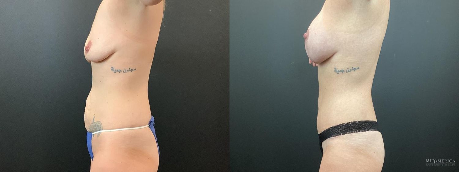 Mommy Makeover Before & After