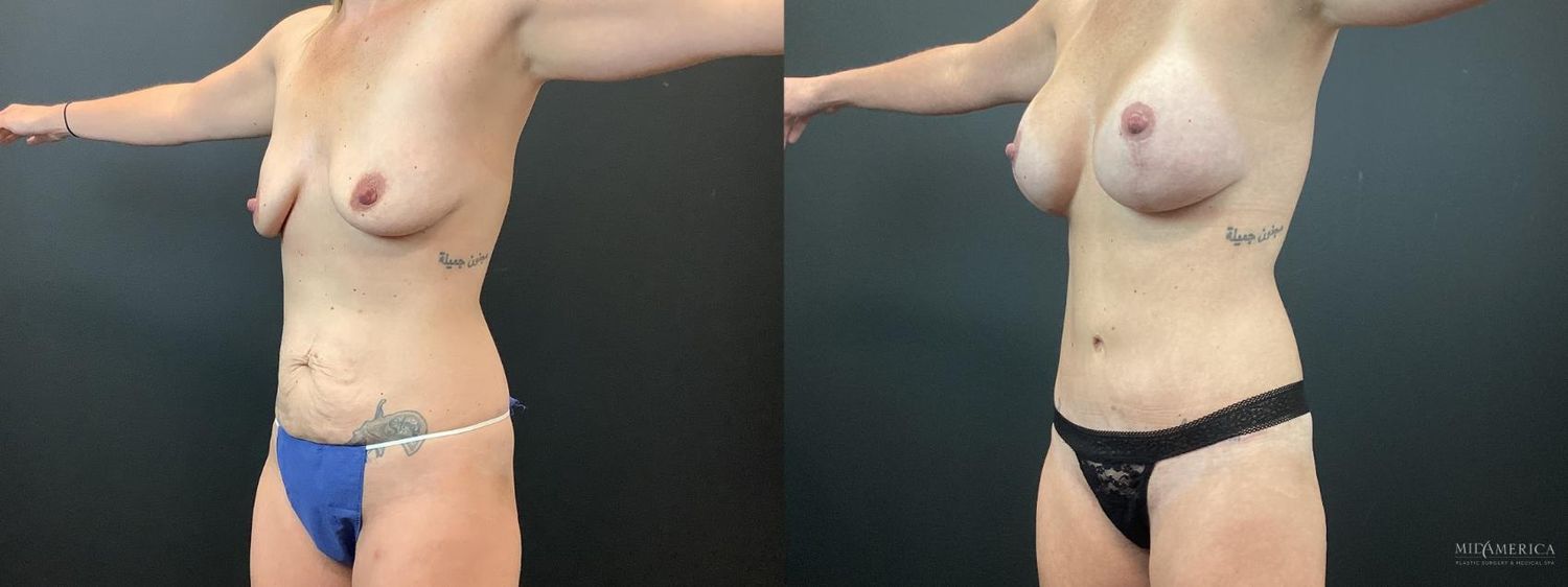 Mommy Makeover Before & After