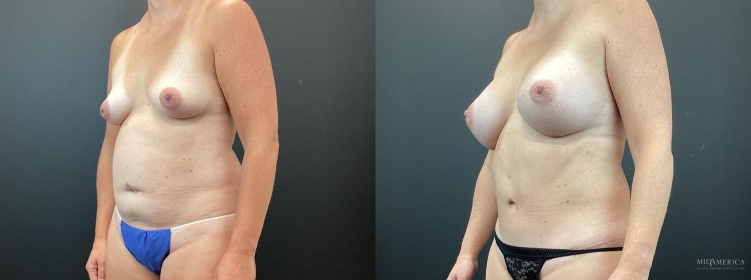 Mommy Makeover Before & After