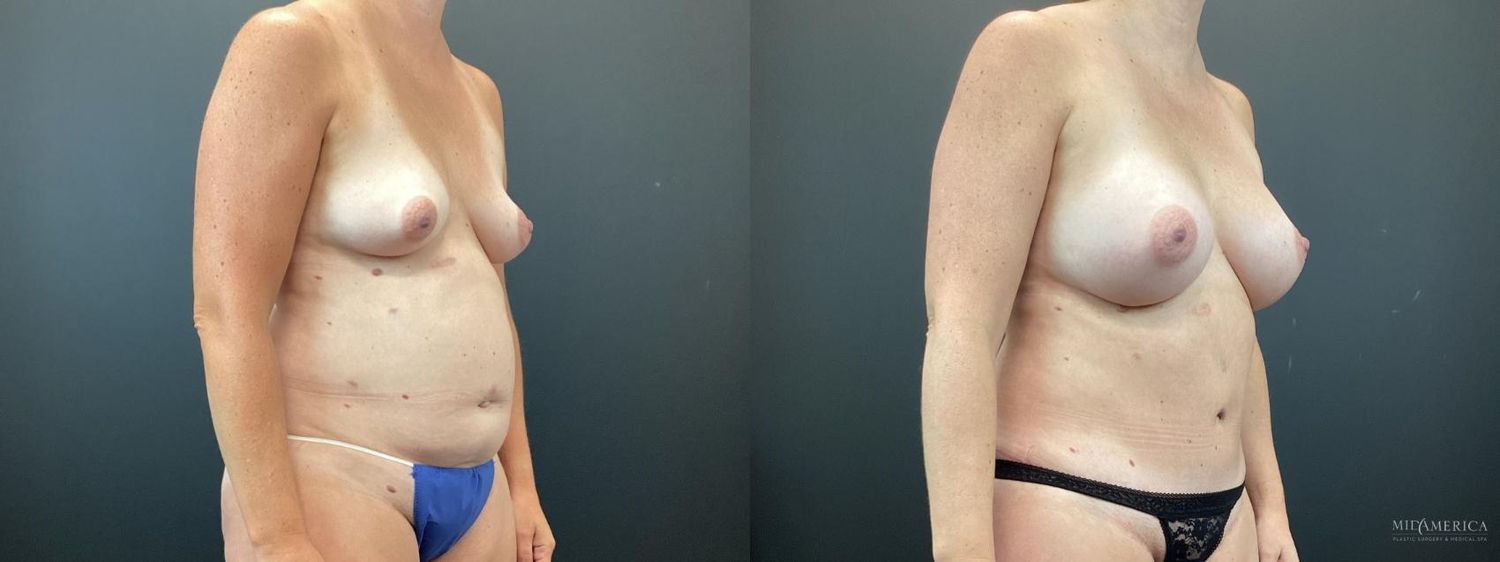 Mommy Makeover Before & After