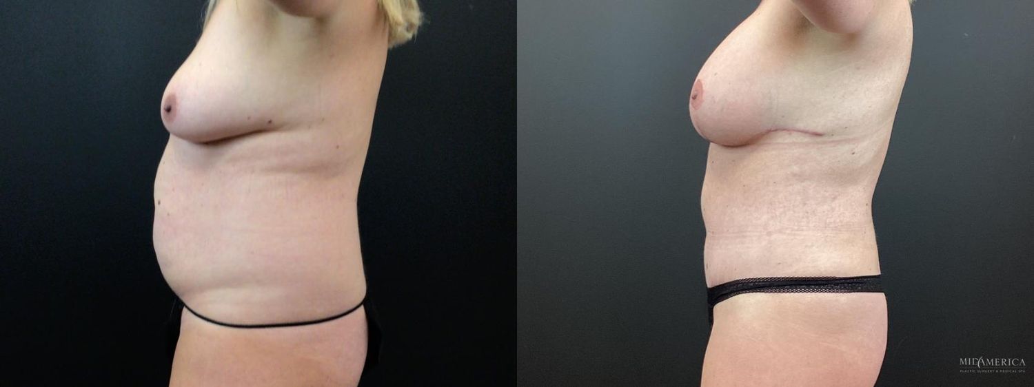 Mommy Makeover Before & After