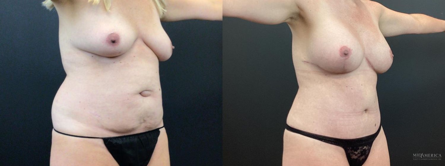 Mommy Makeover Before & After