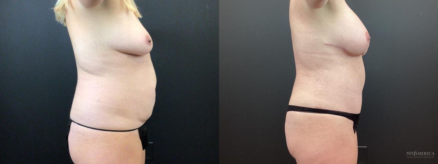 Mommy Makeover Before & After