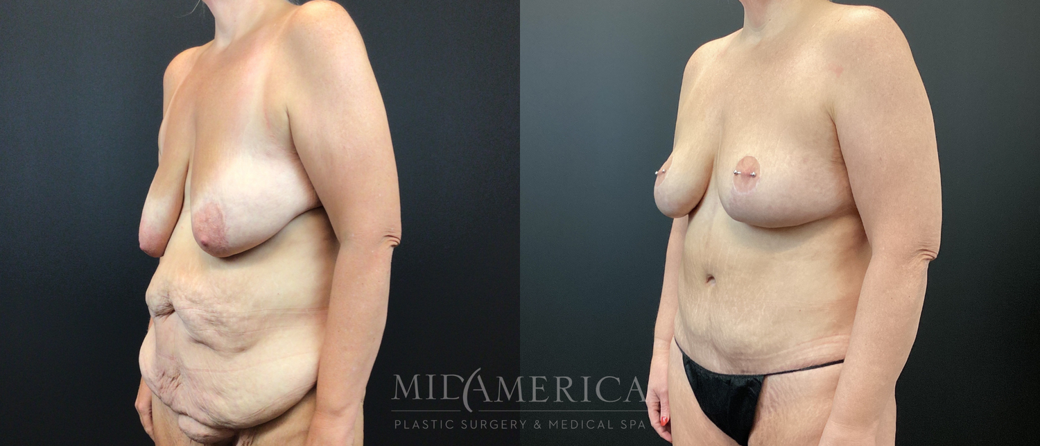 Mommy Makeover Before & After