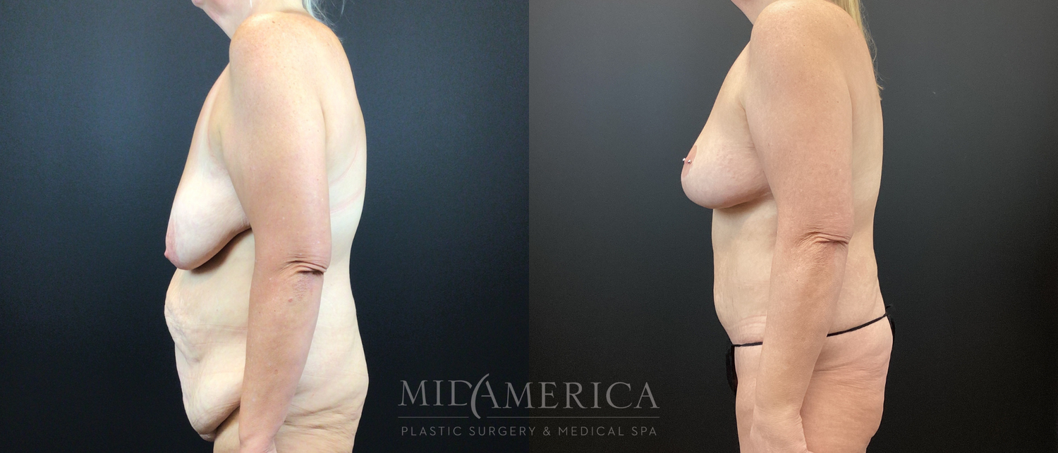 Mommy Makeover Before & After