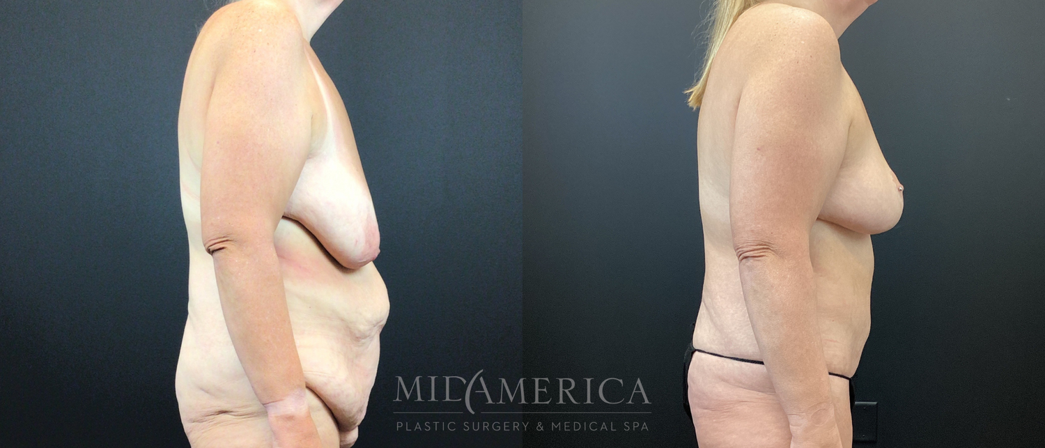 Mommy Makeover Before & After