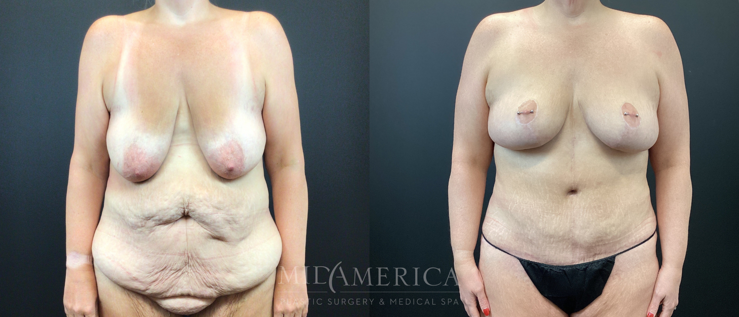 Mommy Makeover Before & After
