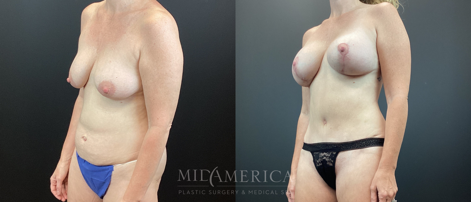 Mommy Makeover Before & After