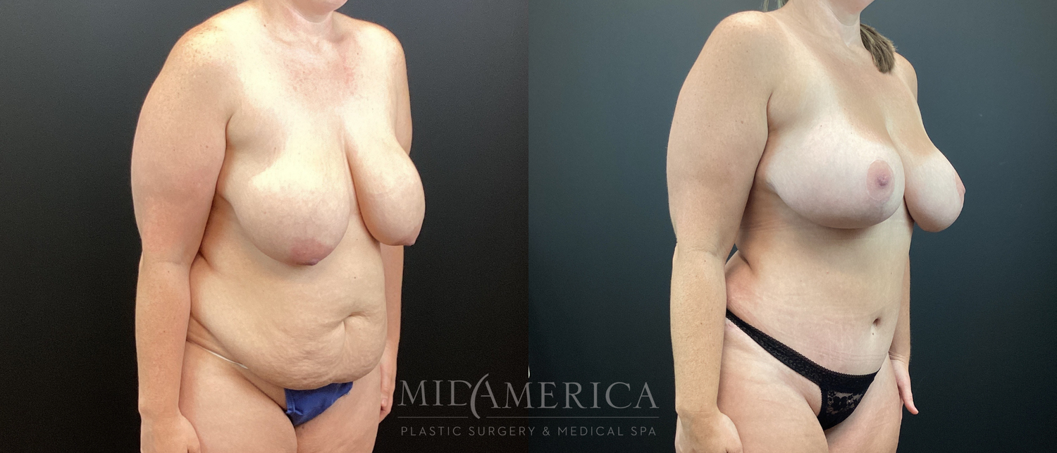 Mommy Makeover Before & After