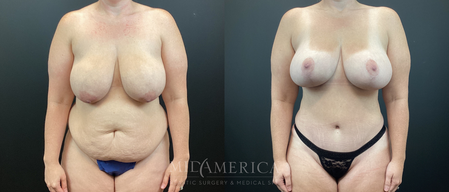 Mommy Makeover Before & After