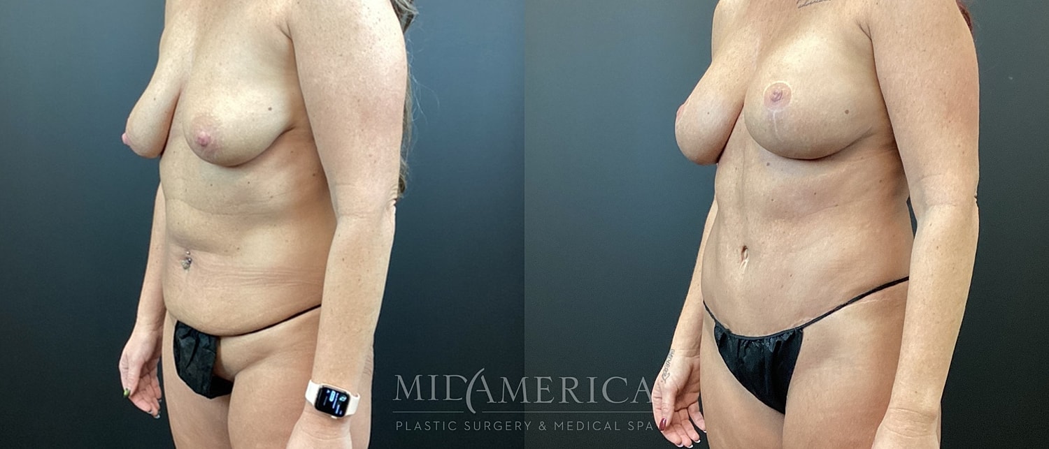 Mommy Makeover Before & After