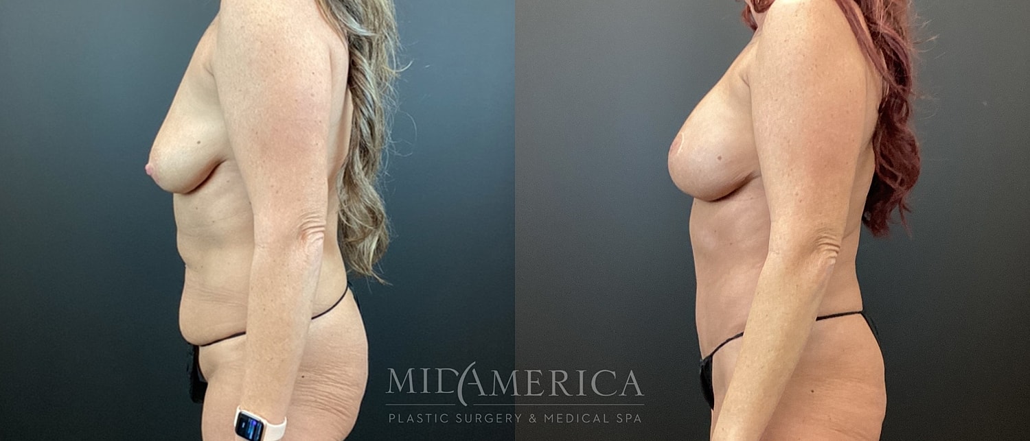 Mommy Makeover Before & After