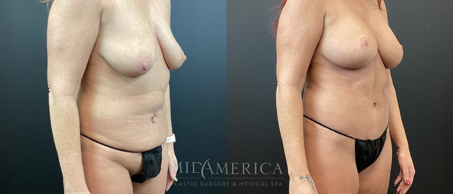 Mommy Makeover Before & After