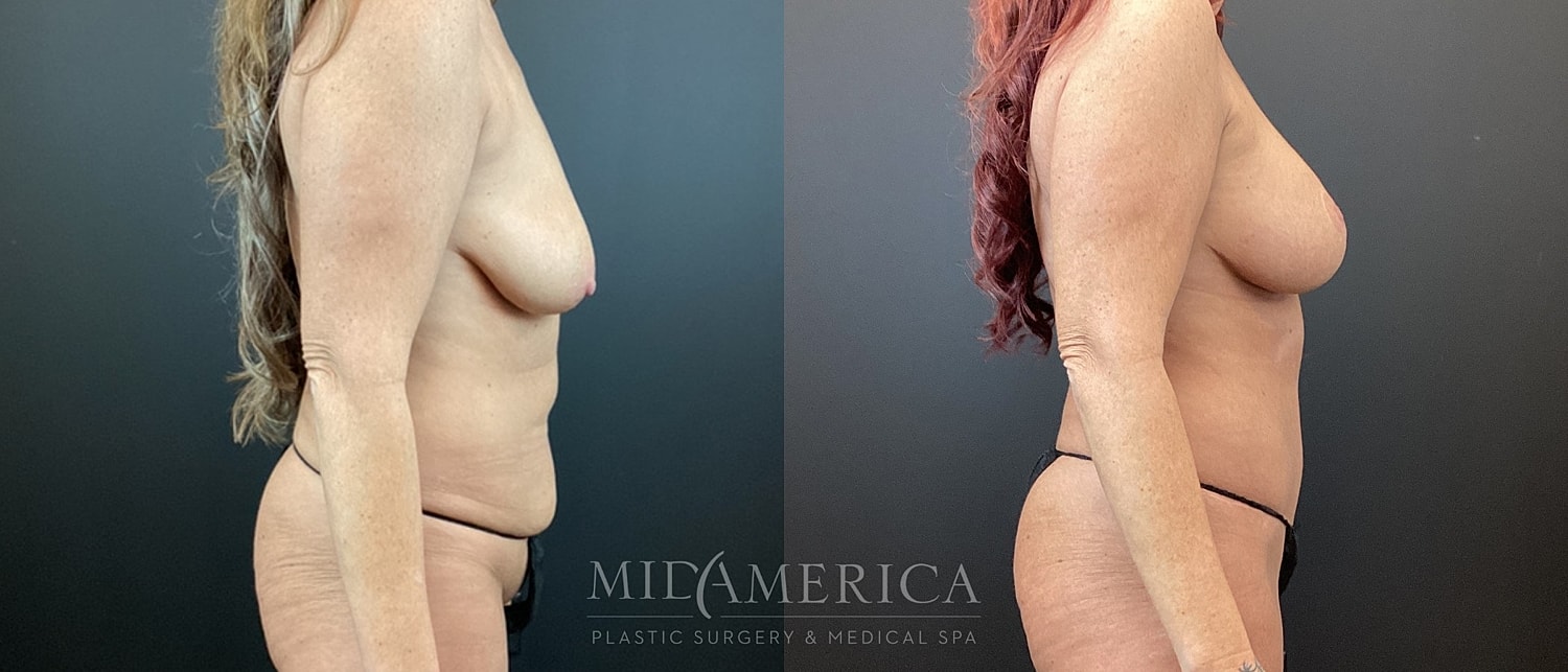 Mommy Makeover Before & After