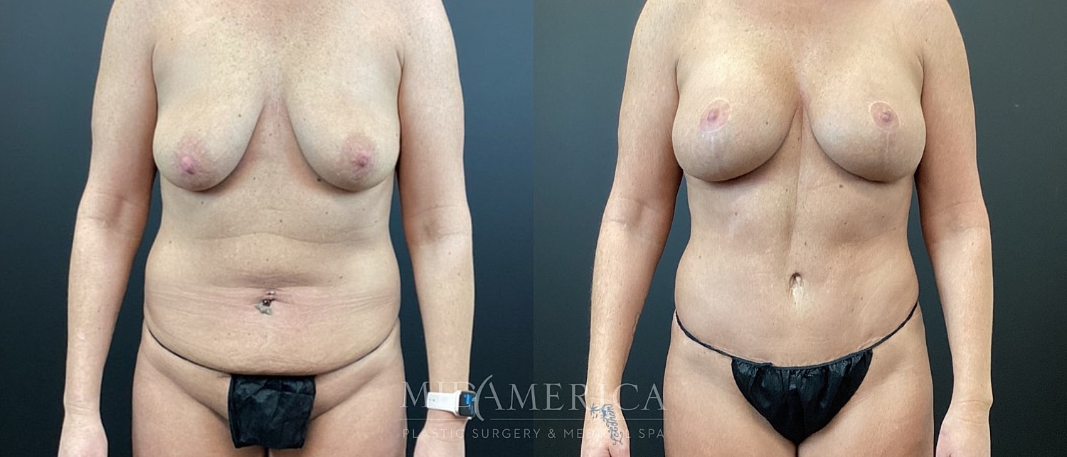 Mommy Makeover Before & After