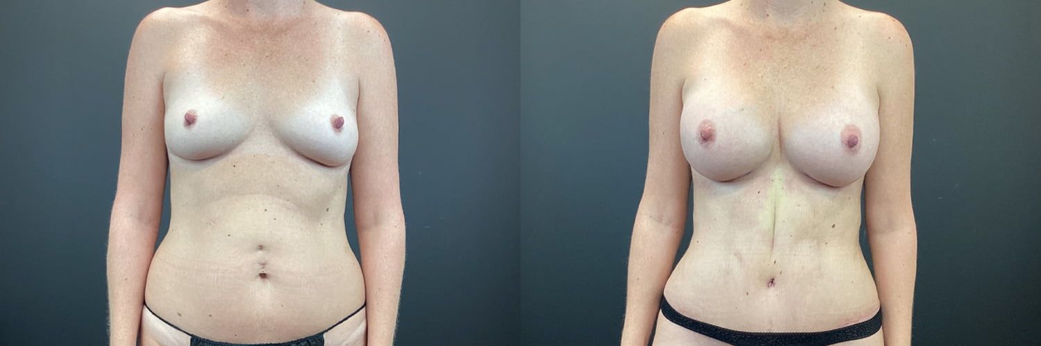 Mommy Makeover Before & After