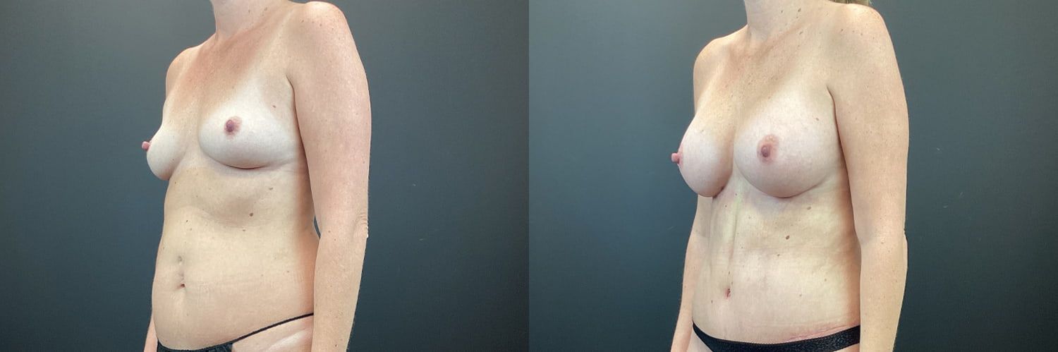 Mommy Makeover Before & After